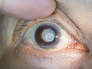 Nahaufnahme eines menschlichen Auges mit sichtbarer grauer Star-Erkrankung (Katarakt), bei der die Linse trüb erscheint. Das Auge wird mit einem Finger leicht geöffnet, um die Trübung deutlich zu zeigen.