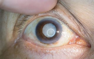 Nahaufnahme eines menschlichen Auges mit sichtbarer grauer Star-Erkrankung (Katarakt), bei der die Linse trüb erscheint. Das Auge wird mit einem Finger leicht geöffnet, um die Trübung deutlich zu zeigen.