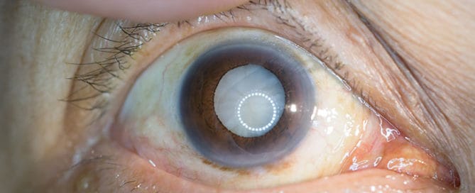 Nahaufnahme eines menschlichen Auges mit sichtbarer grauer Star-Erkrankung (Katarakt), bei der die Linse trüb erscheint. Das Auge wird mit einem Finger leicht geöffnet, um die Trübung deutlich zu zeigen.