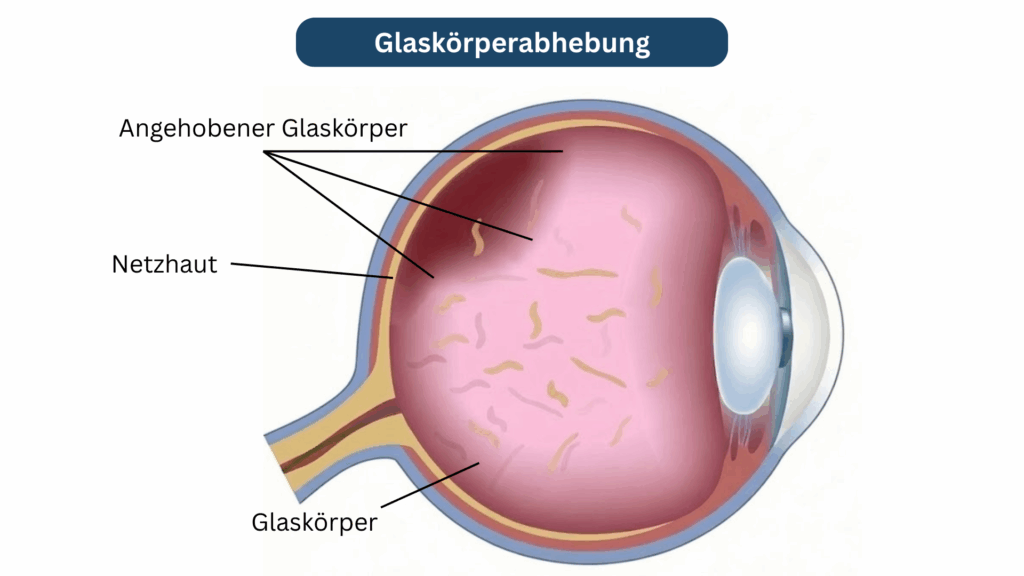 Querschnitt eines Auges mit Beschriftung zur Glaskörperabhebung. Der angehobene Glaskörper löst sich von der Netzhaut, beides ist farblich und mit Linien markiert.