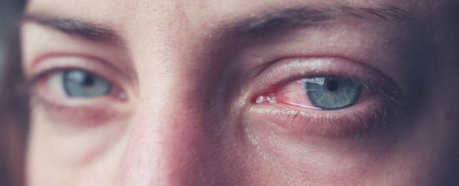 epidemische bindehautentzuendung