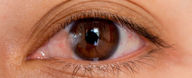 fluegelfell pterygium