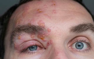 Augenherpes