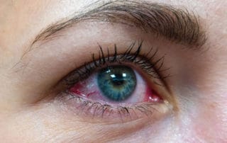 endophthalmitis