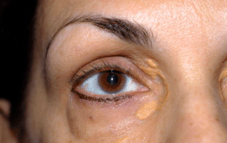 xanthelasma am auge kopie