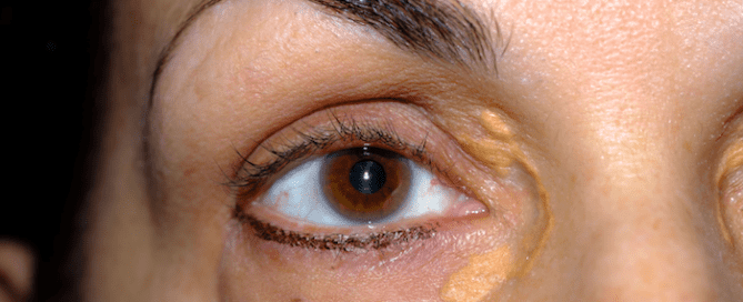 xanthelasma am auge kopie