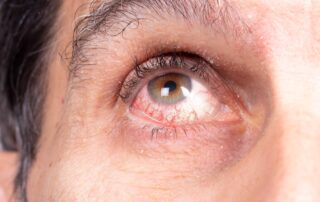 Nahaufnahme eines menschlichen Auges. Das Auge ist braun und leicht gerötet, mit sichtbaren roten Äderchen in der Bindehaut. Die Pupille ist rund und normal erweitert. Die Haut um das Auge zeigt feine Falten, sichtbare Poren und einige vereinzelte graue Haare in der Augenbraue. Das Bild zeigt den oberen Teil einer Wange, das Unterlid und das obere Lid mit natürlichen Hautstrukturen.
