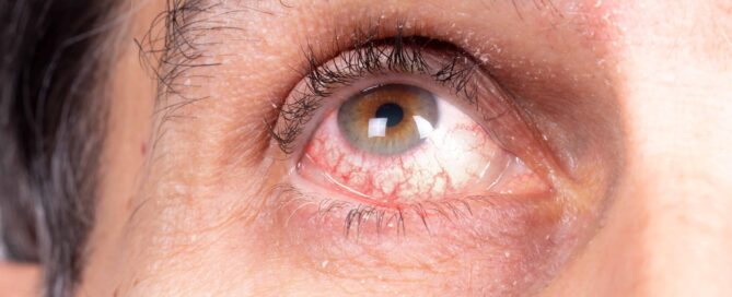 Nahaufnahme eines menschlichen Auges. Das Auge ist braun und leicht gerötet, mit sichtbaren roten Äderchen in der Bindehaut. Die Pupille ist rund und normal erweitert. Die Haut um das Auge zeigt feine Falten, sichtbare Poren und einige vereinzelte graue Haare in der Augenbraue. Das Bild zeigt den oberen Teil einer Wange, das Unterlid und das obere Lid mit natürlichen Hautstrukturen.
