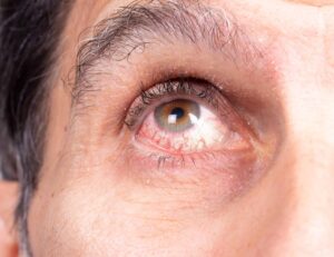 Nahaufnahme eines menschlichen Auges. Das Auge ist braun und leicht gerötet, mit sichtbaren roten Äderchen in der Bindehaut. Die Pupille ist rund und normal erweitert. Die Haut um das Auge zeigt feine Falten, sichtbare Poren und einige vereinzelte graue Haare in der Augenbraue. Das Bild zeigt den oberen Teil einer Wange, das Unterlid und das obere Lid mit natürlichen Hautstrukturen.