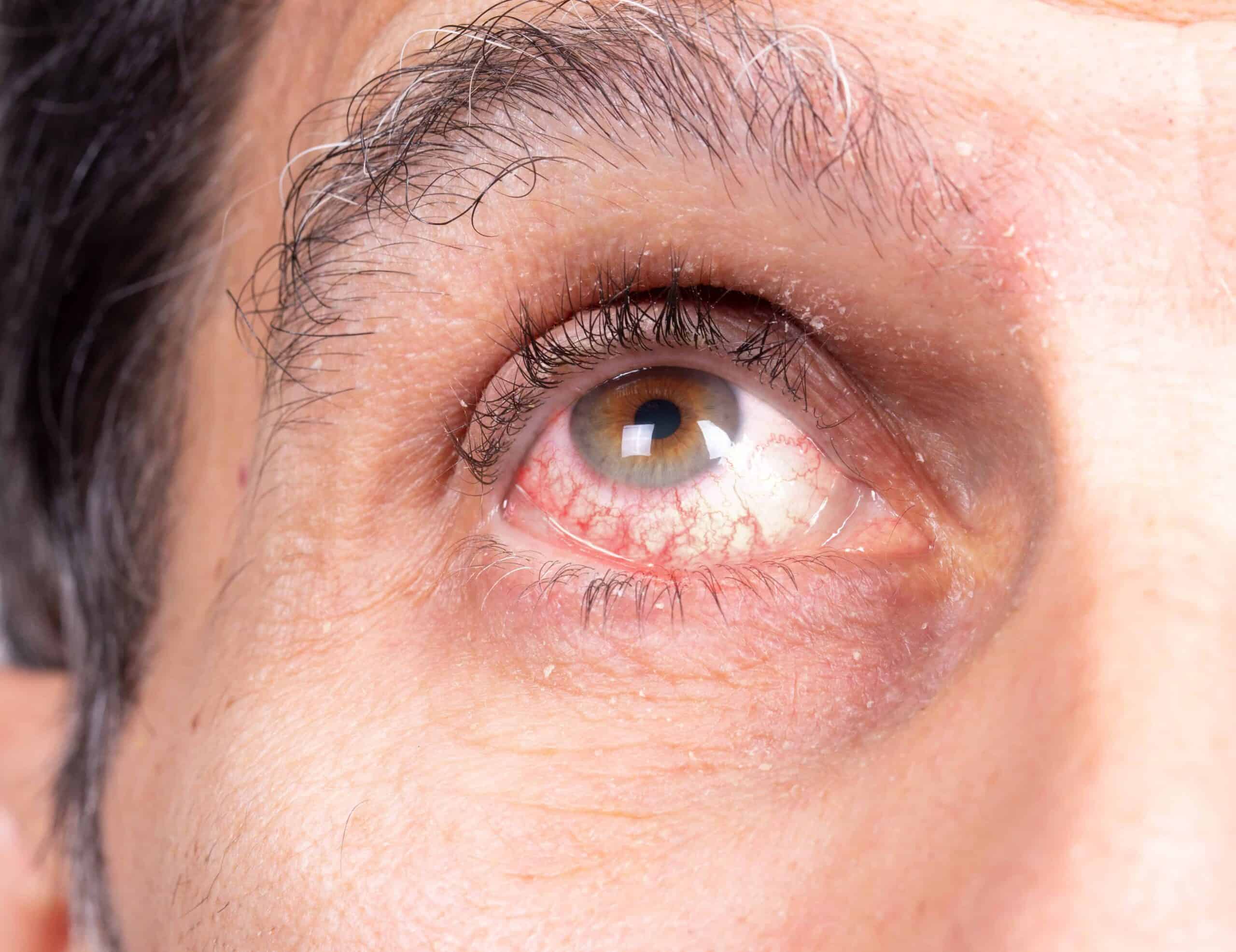 Nahaufnahme eines menschlichen Auges. Das Auge ist braun und leicht gerötet, mit sichtbaren roten Äderchen in der Bindehaut. Die Pupille ist rund und normal erweitert. Die Haut um das Auge zeigt feine Falten, sichtbare Poren und einige vereinzelte graue Haare in der Augenbraue. Das Bild zeigt den oberen Teil einer Wange, das Unterlid und das obere Lid mit natürlichen Hautstrukturen.
