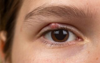 Nahaufnahme eines braunen Auges mit geschwollener, geröteter Stelle am oberen Lidrand. Die Haut ist glatt. Die Wimpern und Brauen sind deutlich sichtbar.