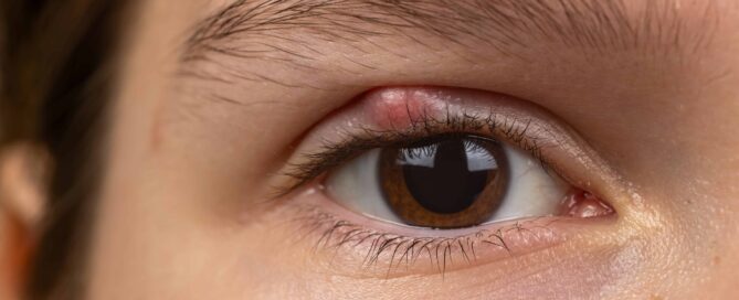 Nahaufnahme eines braunen Auges mit geschwollener, geröteter Stelle am oberen Lidrand. Die Haut ist glatt. Die Wimpern und Brauen sind deutlich sichtbar.