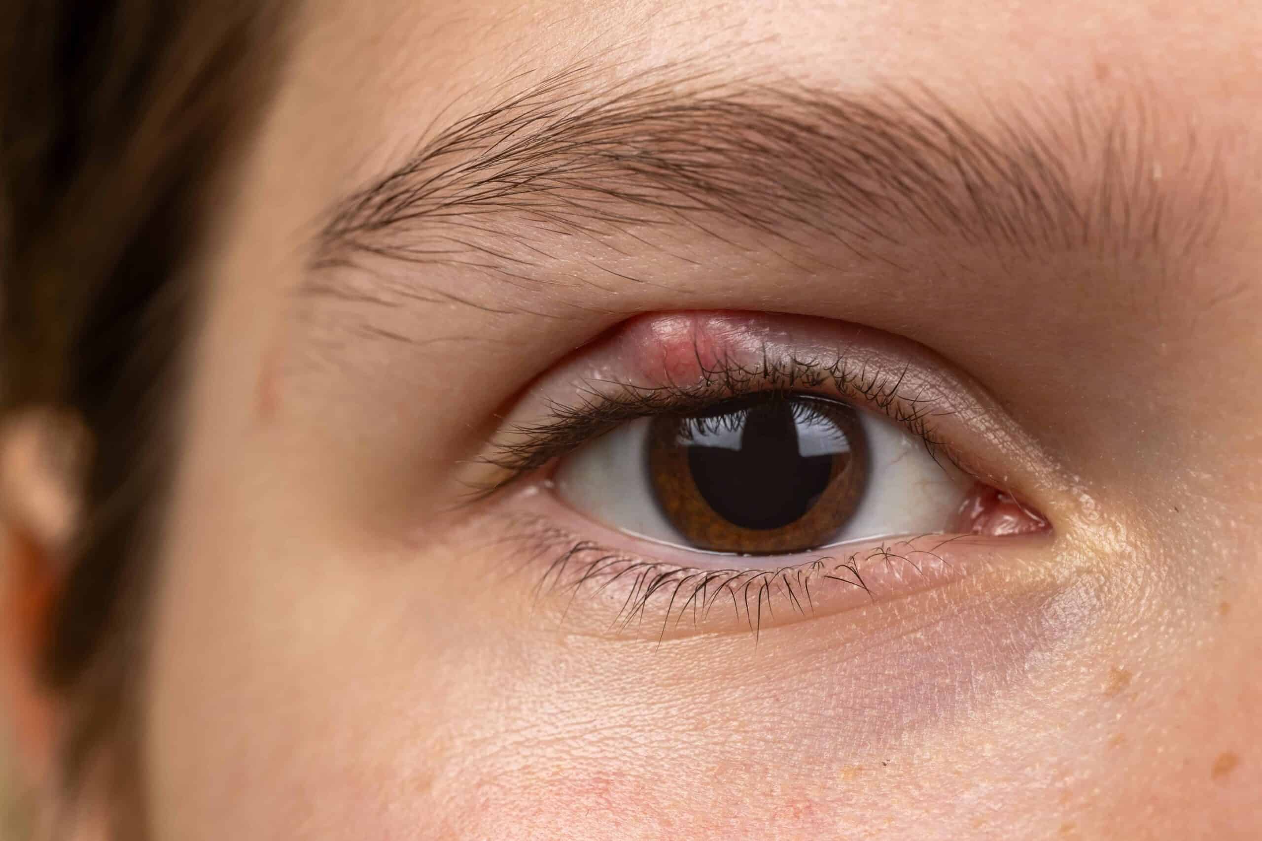 Nahaufnahme eines braunen Auges mit geschwollener, geröteter Stelle am oberen Lidrand. Die Haut ist glatt. Die Wimpern und Brauen sind deutlich sichtbar.